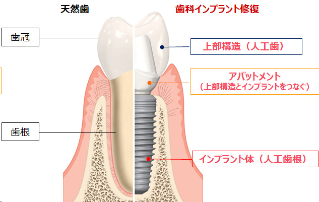 インプラント治療とは？