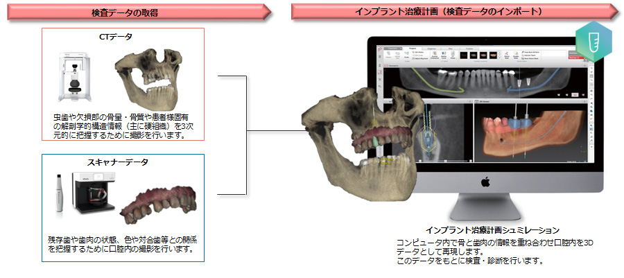 より安心なインプラント治療のために